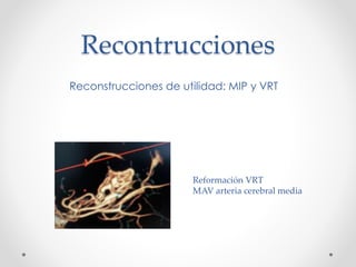 Recontrucciones
Reconstrucciones de utilidad: MIP y VRT
Reformación VRT
MAV arteria cerebral media
 
