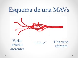 Esquema de una MAVs
Varias
arterias
aferentes
“nidus” Una vena
eferente
 