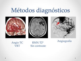 Métodos diagnósticos
Angiografía
RMN T2*
Sin contraste
Angio TC
VRT
 