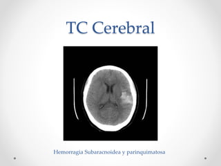 TC Cerebral
Hemorragia Subaracnoidea y parinquimatosa
 