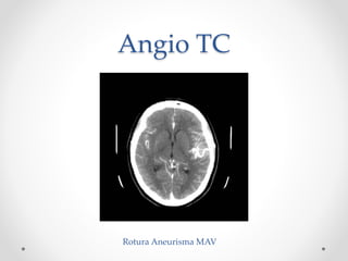 Angio TC
Rotura Aneurisma MAV
 