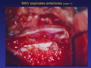 MAV espinales anteriores  (caso 1) 