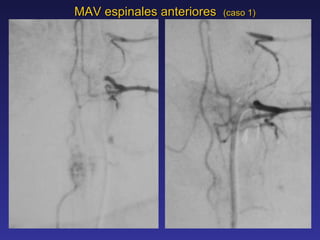 MAV espinales anteriores  (caso 1) 