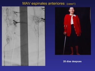 MAV espinales anteriores  (caso1) 20 dias despues 