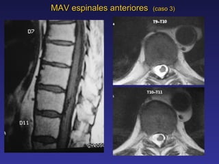 MAV  espinales  anteriores  (caso 3) 