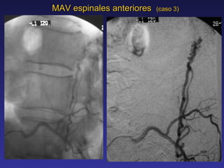 MAV espinales anteriores  (caso 3) 