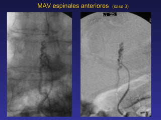 MAV espinales anteriores  (caso 3) 