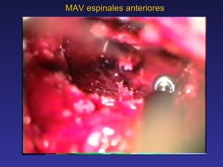 MAV espinales anteriores VIDEO 