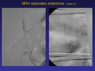 MAV espinales anteriores  (caso 3) 