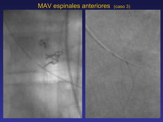 MAV espinales anteriores  (caso 3) 