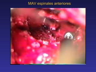 MAV espinales anteriores 