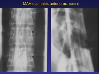 MAV espinales anteriores  (caso 1) T-10 T-11 