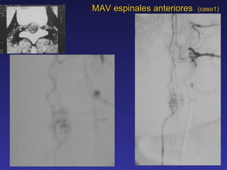 MAV espinales anteriores  (caso1) 