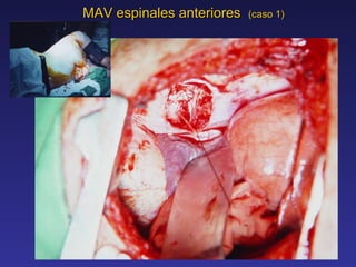 MAV espinales anteriores  (caso 1) 