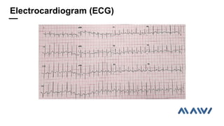 Electrocardiogram (ECG)
 