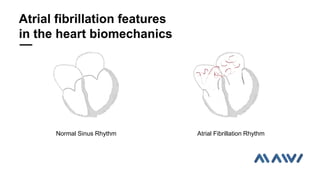 Atrial fibrillation features
in the heart biomechanics
Normal Sinus Rhythm Atrial Fibrillation Rhythm
 