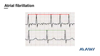 Atrial fibrillation
 