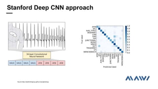 Source:https://stanfordmlgroup.github.io/projects/ecg/
Stanford Deep CNN approach
 
