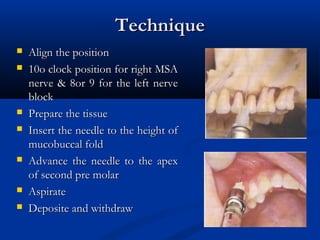 Technique











Align the position
10o clock position for right MSA
nerve & 8or 9 for the left nerve
block
Prepare the tissue
Insert the needle to the height of
mucobuccal fold
Advance the needle to the apex
of second pre molar
Aspirate
Deposite and withdraw

 