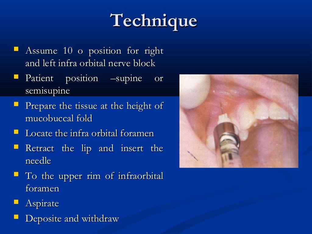 Maxillary Injection Technique