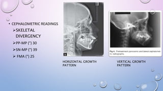 • CEPHALOMETRIC READINGS
SKELETAL
DIVERGENCY
PP-MP (°) 30
SN-MP (°) 39
 FMA (°) 25
VERTICAL GROWTH
PATTERN
HORIZONTAL GROWTH
PATTERN
 
