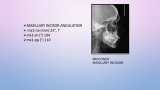 MAXILLARY INCISOR ANGULATION
 mx1-na (mm) 23°, 7
mx1-sn (°) 104
mx1-pp (°) 110
PROCLINED
MAXILLARY INCISORS
 