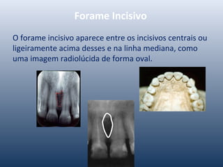 Forame Incisivo
O forame incisivo aparece entre os incisivos centrais ou
ligeiramente acima desses e na linha mediana, como
uma imagem radiolúcida de forma oval.
 