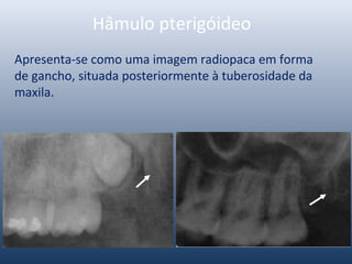 Hâmulo pterigóideo
Apresenta-se como uma imagem radiopaca em forma
de gancho, situada posteriormente à tuberosidade da
maxila.
 