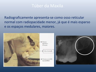 Túber da Maxila
Radiograficamente apresenta-se como osso reticular
normal com radiopacidade menor, já que é mais esparso
e os espaços medulares, maiores.
 