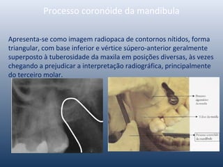 Processo coronóide da mandibula
Apresenta-se como imagem radiopaca de contornos nítidos, forma
triangular, com base inferior e vértice súpero-anterior geralmente
superposto à tuberosidade da maxila em posições diversas, às vezes
chegando a prejudicar a interpretação radiográfica, principalmente
do terceiro molar.
 