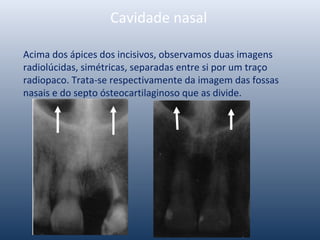 Cavidade nasal
Acima dos ápices dos incisivos, observamos duas imagens
radiolúcidas, simétricas, separadas entre si por um traço
radiopaco. Trata-se respectivamente da imagem das fossas
nasais e do septo ósteocartilaginoso que as divide.
 
