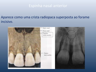 Espinha nasal anterior
Aparece como uma crista radiopaca superposta ao forame
incisivo.
 