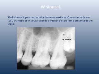 W sinusal
São linhas radiopacas no interior dos seios maxilares. Com aspecto de um
“W”, chamado de Wsinusal quando o interior do seio tem a presença de um
septo.
 
