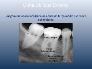 Linha Oblíqua Externa
Imagem radiopaca localizada na altura do terço médio das raízes
dos molares.
 