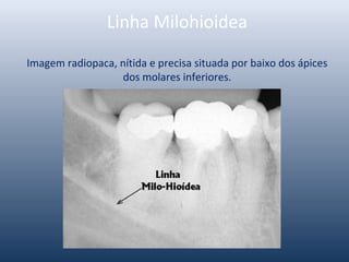 Linha Milohioidea
Imagem radiopaca, nítida e precisa situada por baixo dos ápices
dos molares inferiores.
 