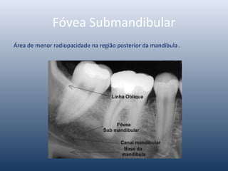 Fóvea Submandibular
Área de menor radiopacidade na região posterior da mandíbula .
 