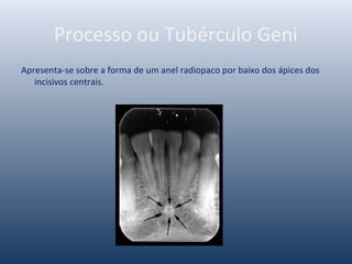 Processo ou Tubérculo Geni
Apresenta-se sobre a forma de um anel radiopaco por baixo dos ápices dos
incisivos centrais.
 