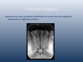 Forame Lingual
Apresenta-se como um ponto radiolúcido, no centro do anel radiopaco,
observado na região de incisivos.
 