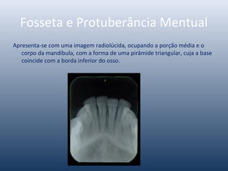 Fosseta e Protuberância Mentual
Apresenta-se com uma imagem radiolúcida, ocupando a porção média e o
corpo da mandíbula, com a forma de uma pirâmide triangular, cuja a base
coincide com a borda inferior do osso.
 
