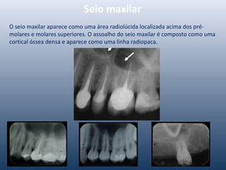 Seio maxilar
O seio maxilar aparece como uma área radiolúcida localizada acima dos pré-
molares e molares superiores. O assoalho do seio maxilar é composto como uma
cortical óssea densa e aparece como uma linha radiopaca.
 