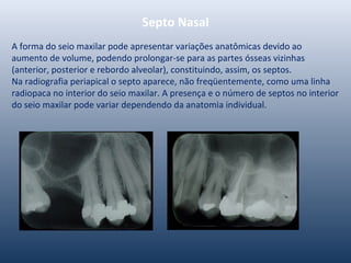 Septo Nasal
A forma do seio maxilar pode apresentar variações anatômicas devido ao
aumento de volume, podendo prolongar-se para as partes ósseas vizinhas
(anterior, posterior e rebordo alveolar), constituindo, assim, os septos.
Na radiografia periapical o septo aparece, não freqüentemente, como uma linha
radiopaca no interior do seio maxilar. A presença e o número de septos no interior
do seio maxilar pode variar dependendo da anatomia individual.
 