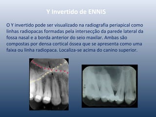Y Invertido de ENNIS
O Y invertido pode ser visualizado na radiografia periapical como
linhas radiopacas formadas pela intersecção da parede lateral da
fossa nasal e a borda anterior do seio maxilar. Ambas são
compostas por densa cortical óssea que se apresenta como uma
faixa ou linha radiopaca. Localiza-se acima do canino superior.
 