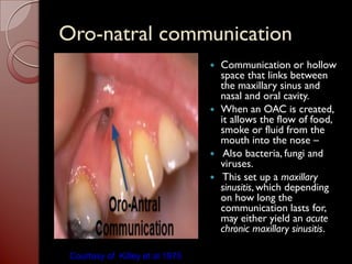 Maxilary sinus | PDF