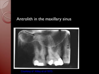 Maxilary sinus | PDF