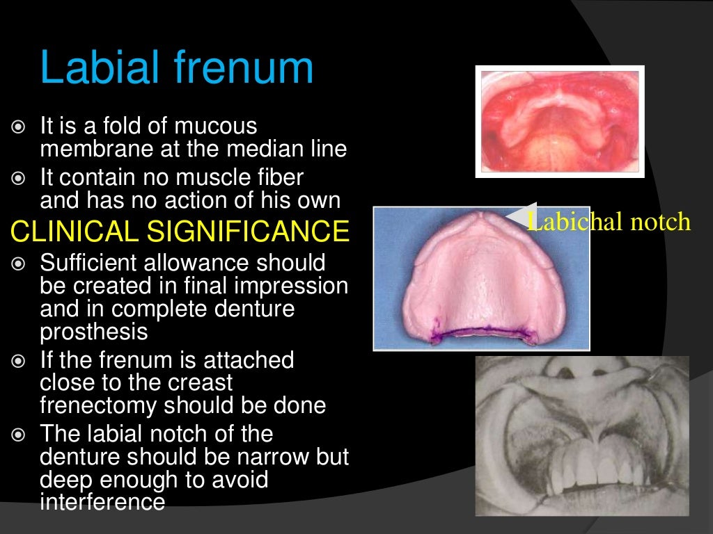 significance of maxillary denture bearing area