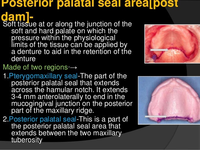 significance of maxillary denture bearing area hamular notch