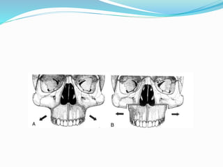 maxillary osteotomies