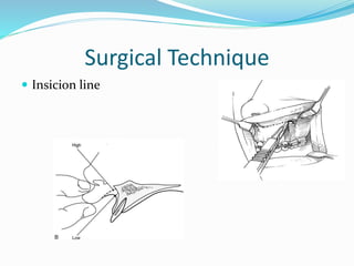 Surgical Technique
 Insicion line
 