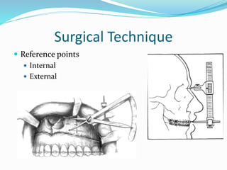 Surgical Technique
 Reference points
 Internal
 External
 