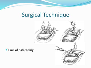 Surgical Technique
 Line of osteotomy
 